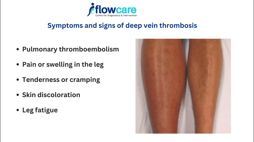 DVT symptoms