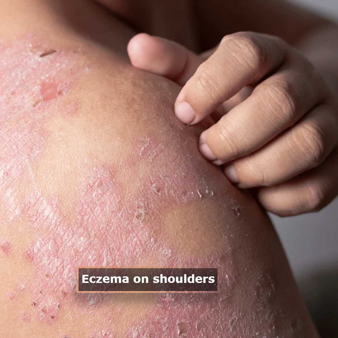 shoulder eczema