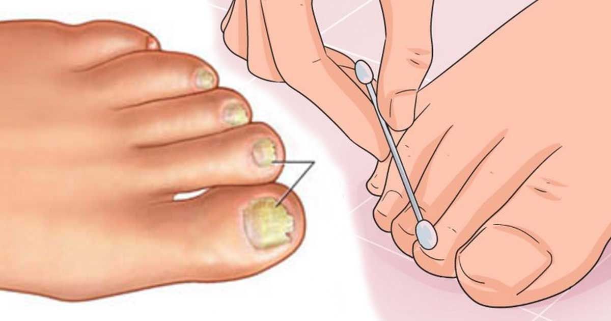 Effective Toenail Fungus Remedies – Foot Specialists in Edinburgh