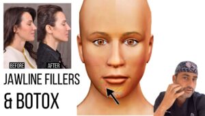 Jawline Botox before and after results showing natural contour enhancement at SF Aesthetic Medspa Bourbonnais IL.