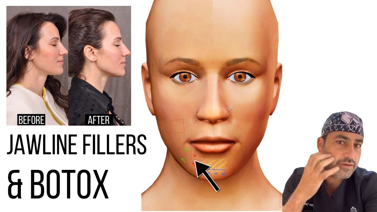 Jawline Botox before and after results showing natural contour enhancement at SF Aesthetic Medspa Bourbonnais IL.