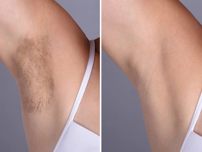 Laser hair removal in Dubai