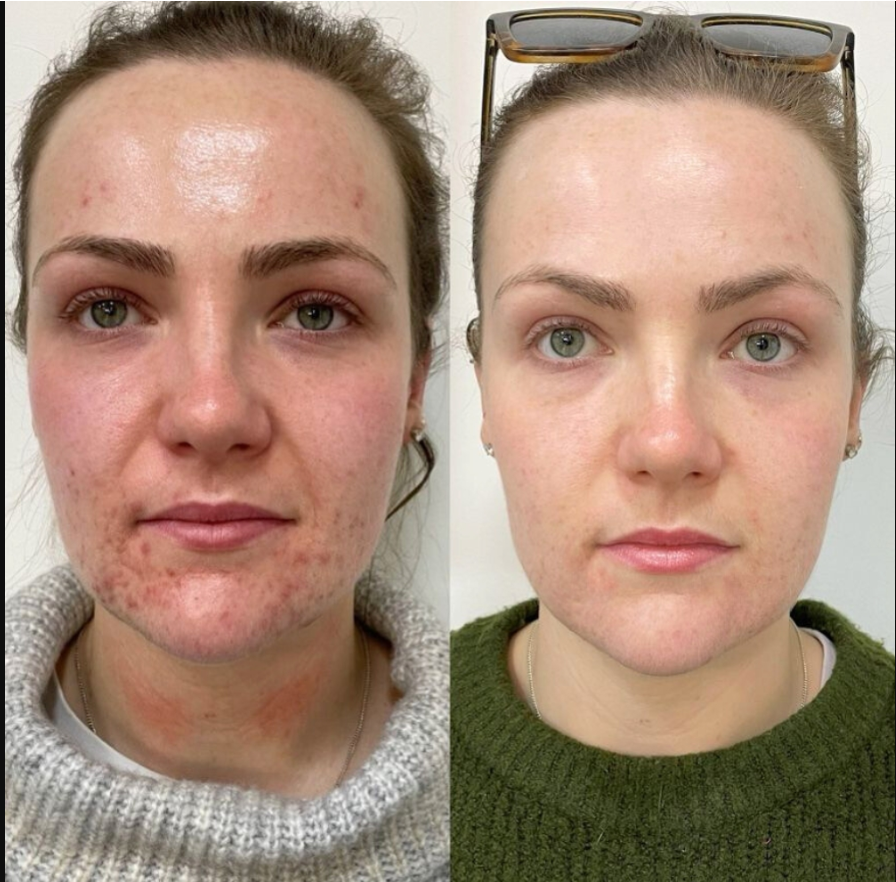 Acne Treatment In Manchester