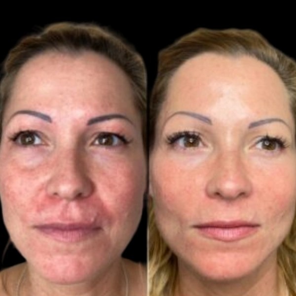 Profhilo treatments in dubai