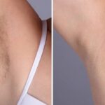 Electrolysis Laser Hair Removal in Dubai