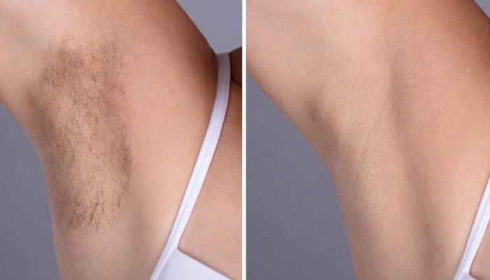 Electrolysis Laser Hair Removal in Dubai,