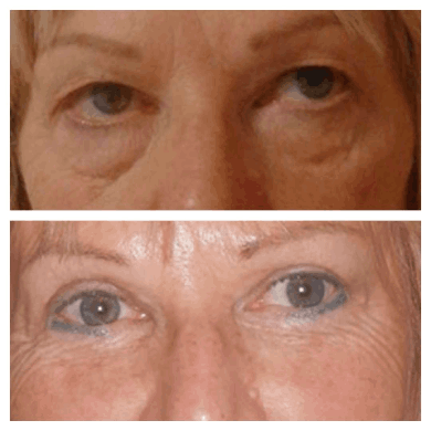 Eye bag removal in Dubai