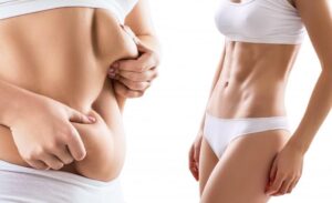 liposuction in dubai