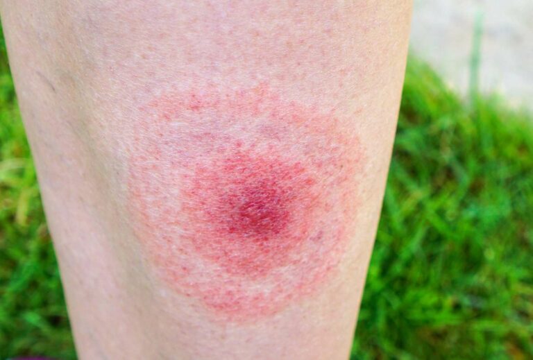 lyme disease treatment germany