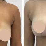 Breast lift in Dubai