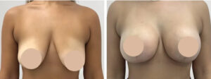 Breast lift in Dubai