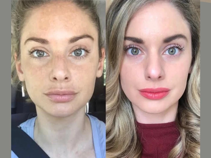 Microneedling in dubai