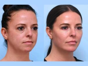 Enhance Facial Definition Effortlessly with Thread Lift Treatment in Dubai