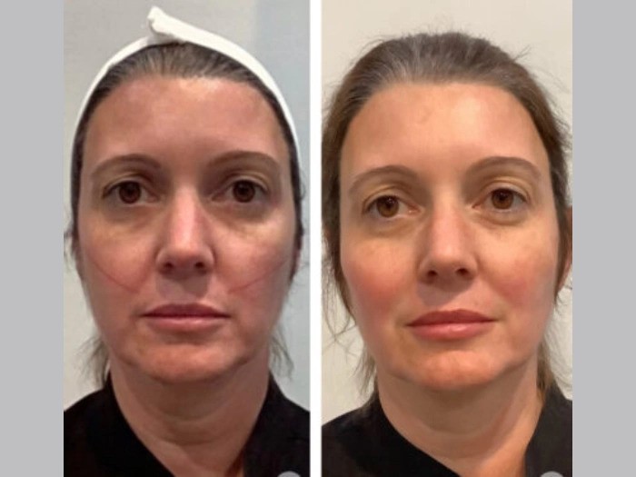 Thread Lift Treatment in Dubai Enhances Facial Contours