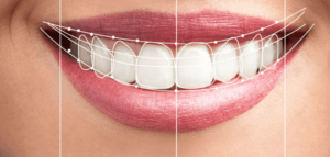 Hollywood Smile makeover in Dubai