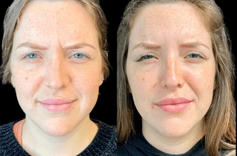 Cost Guide for Botox Treatments in Dubai: What You Need to Know