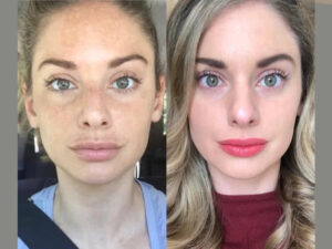 RF-Microneedling IN DUBAI