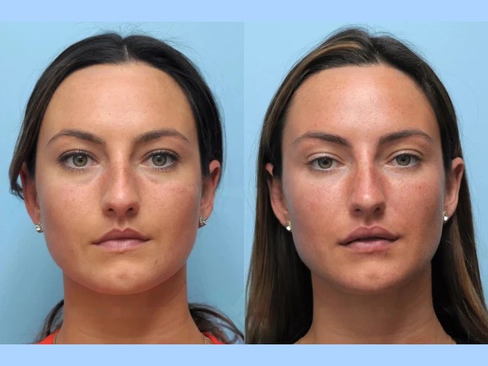 Best Aesthetic Clinics in Dubai: Youthful Thread Lift Results Safely