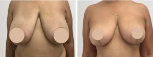 breast reduction in dubai