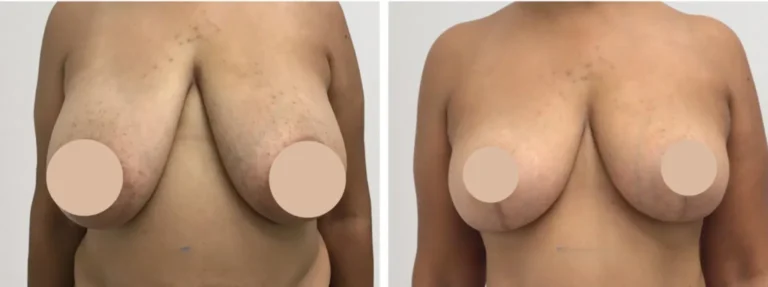 breast reduction in dubai