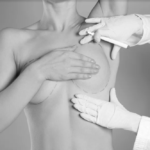 Breast Reduction in Dubai