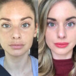 RF Microneedling in Dubai