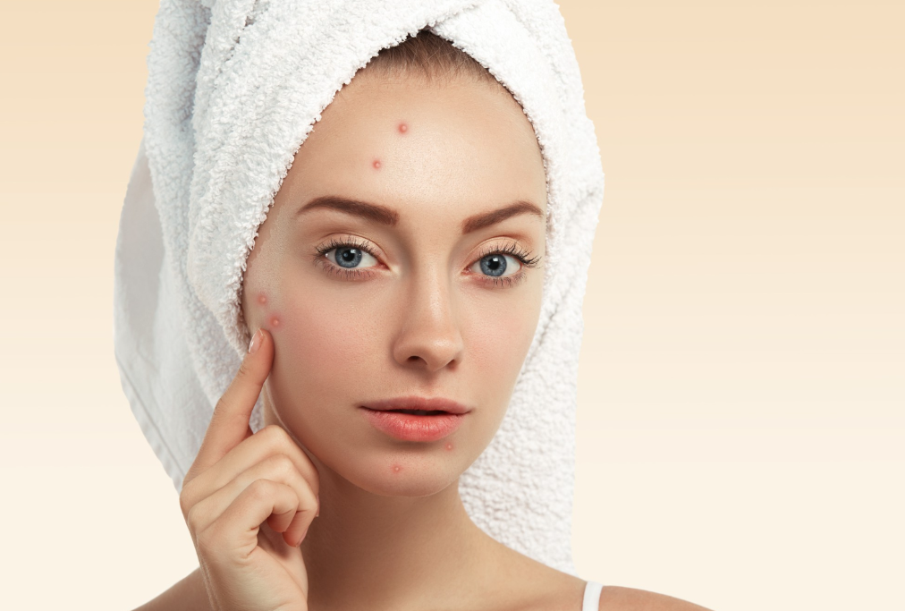 Acne Treatment in Manchester