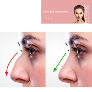 Nose Reshaping London