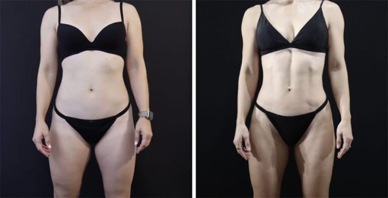 Vaser Liposuction Surgery in Dubai: Expert Tips