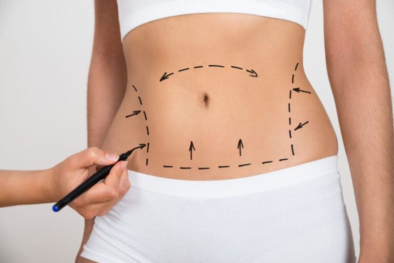 Abdominoplasty in Dubai: Combining Liposuction for Better Results