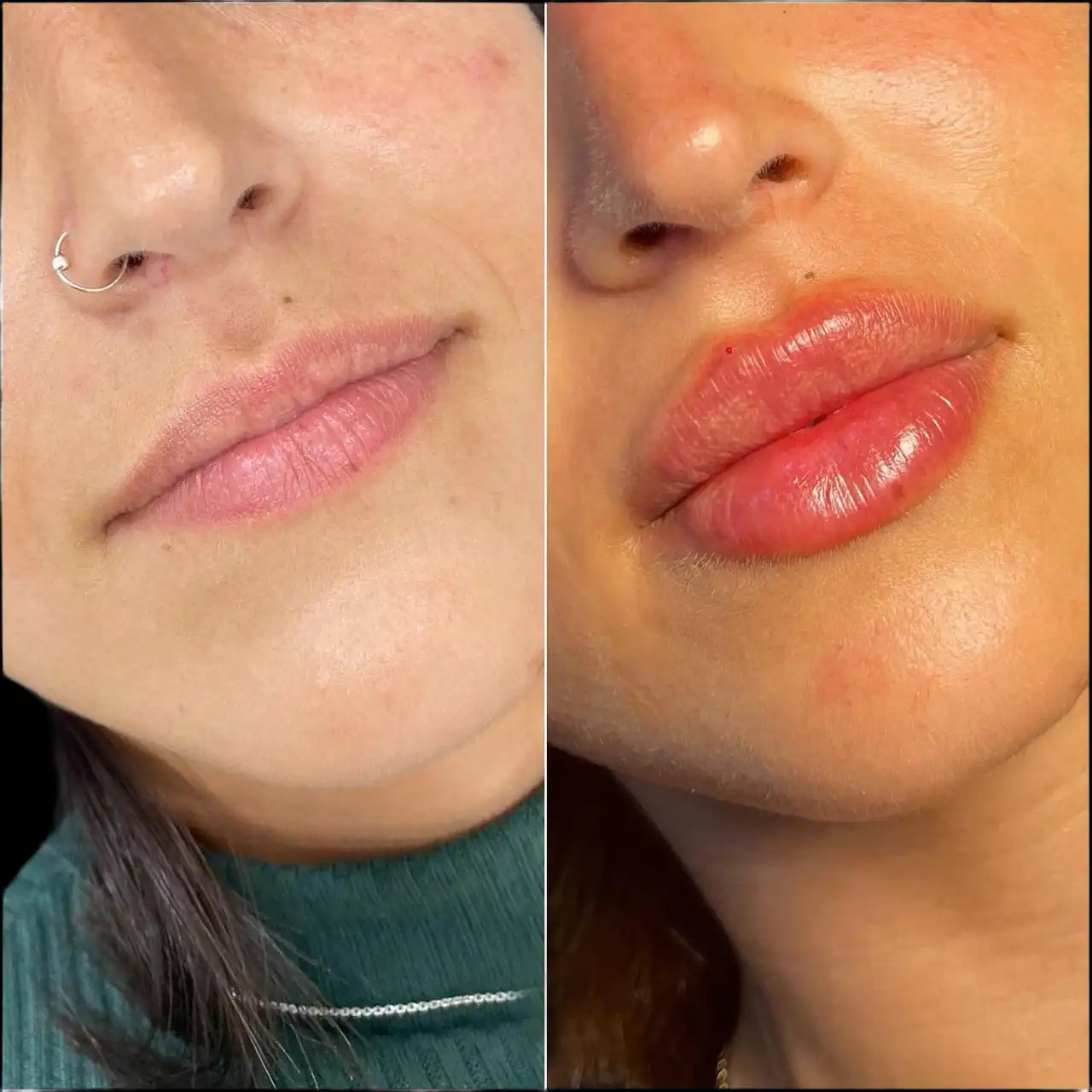Dermal fillers