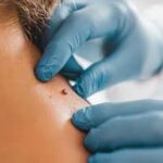 Moles Removal in Dubai