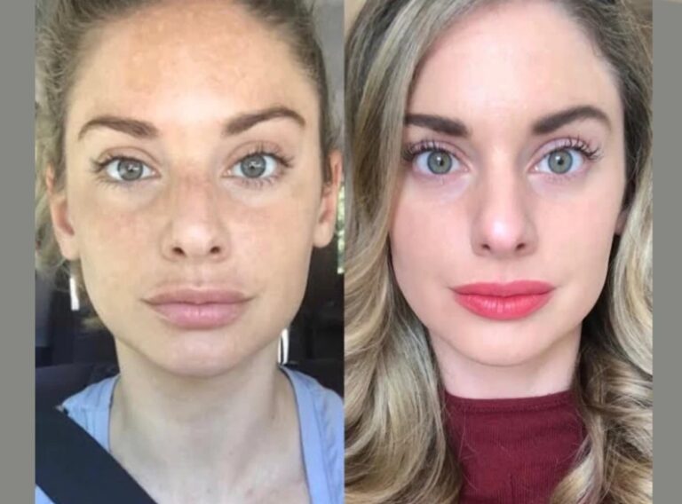 Reliable Doctors in Dubai for RF Microneedling Care
