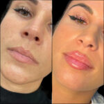 fillers