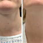 Best Aesthetic Clinics in dubai for Radiofrequency Microneedling Facial Renewal
