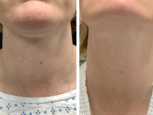 Best Aesthetic Clinics in dubai for Radiofrequency Microneedling Facial Renewal