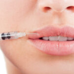 Lip Fillers in London
