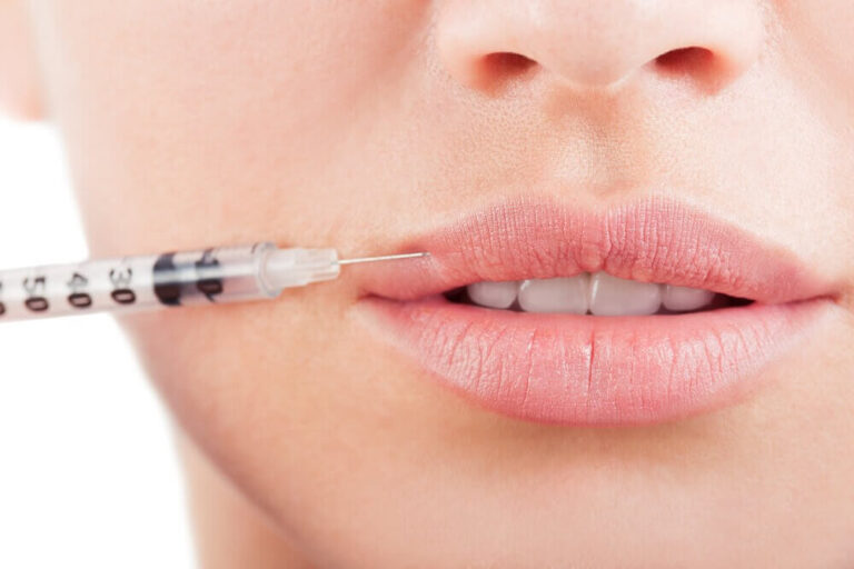 Lip Fillers in London