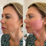 Best Plastic Surgeon in dubai for Endolift Facial Lifting
