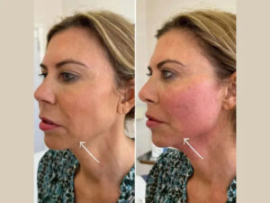Best Plastic Surgeon in dubai for Endolift Facial Lifting