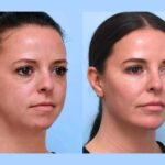 Thread Lift in Dubai: Effective Skin Rejuvenation for Beauty Goals