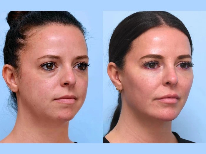 Thread Lift in Dubai: Effective Skin Rejuvenation for Beauty Goals