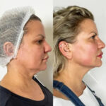 Best Doctors in dubai Explain Endolift Before and After Expectations