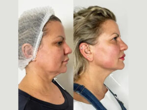 Best Doctors in dubai Explain Endolift Before and After Expectations