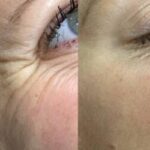 Anti Wrinkle Injections in London