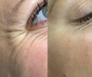 Anti Wrinkle Injections in London